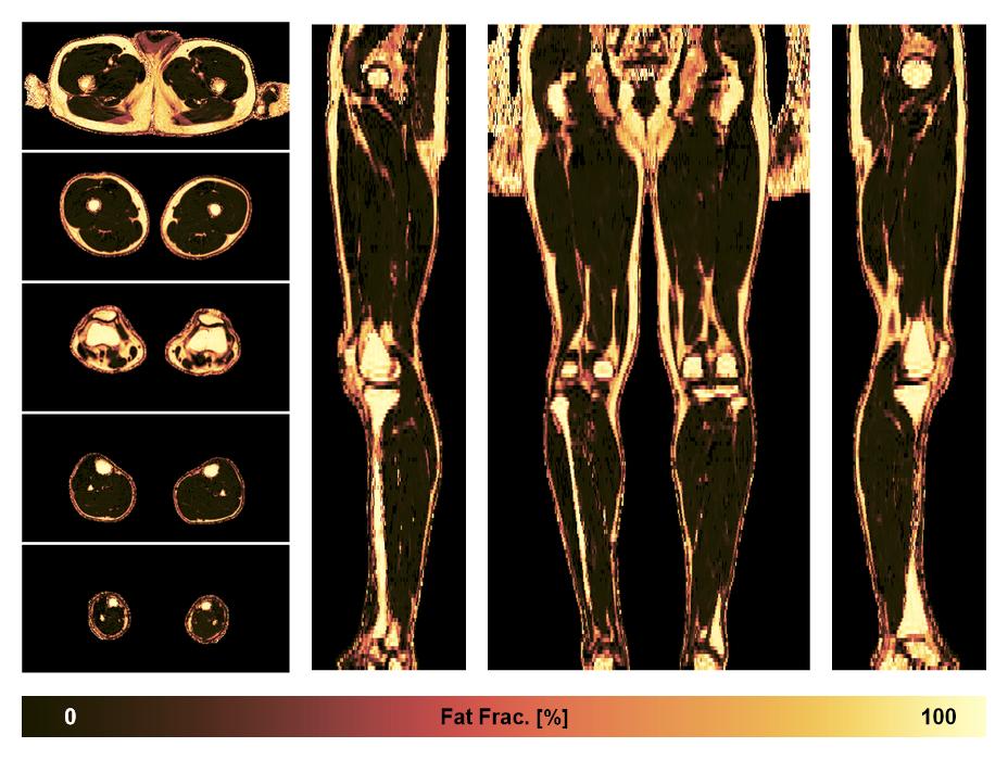 The fat fraction of the lower extremity obtained from the dixon reconstruction for muscle water fat quantification.